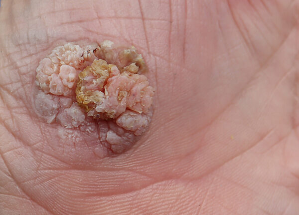 Bowen's disease