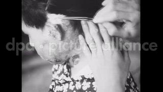 October 1, 1945 – Hiroshima Japan: Atomic bombing effects showing human body injuries and burns, Hiroshima.