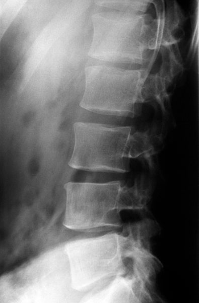 Radiograph of lumbar spine