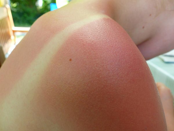 Sonnenbrand, die Tücken des Sommers