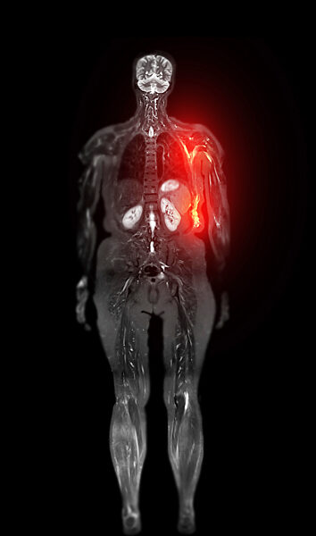 Recurrent breast cancer, MRI scan