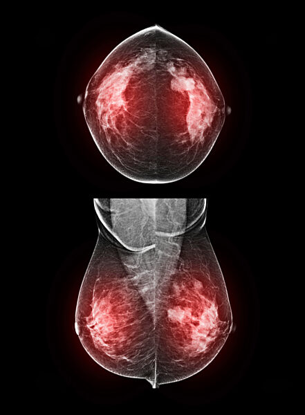 BI-RADS score 5, mammogram
