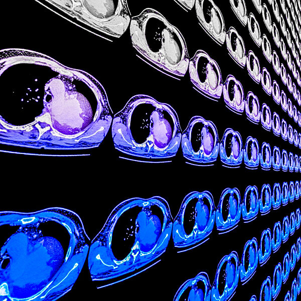 Lung carcinoma, CT scans