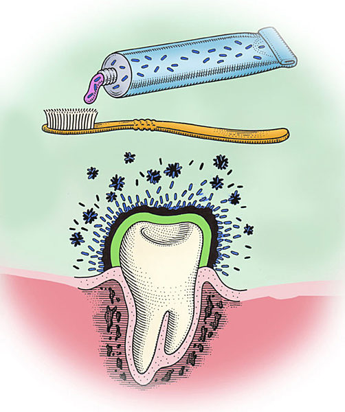 Bakterien bekämpfen Karies