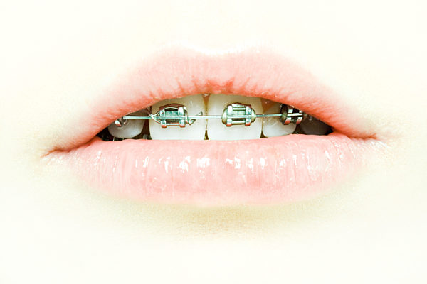 Teenage girl's mouth with braces, extreme close-up